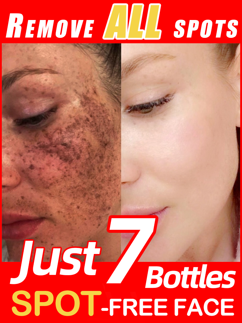تفتيح النمش الكلف، البقع الداك - مراجعة Skincare Luxury Whitening وسعره